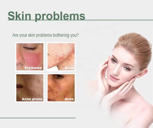 Be Bold Acne Treatment Serum, Cream Herbal Supports Relief of Spots, Blemishes, Whitehead, Blackhead, Pimples Acne Pro active Scar Skincare - Image 3