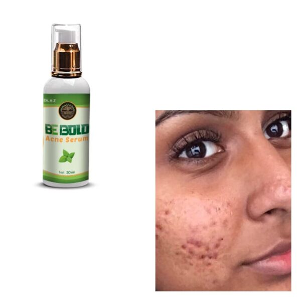 Be Bold Acne Treatment Serum, Cream Herbal Supports Relief of Spots, Blemishes, Whitehead, Blackhead, Pimples Acne Pro active Scar Skincare - Image 7
