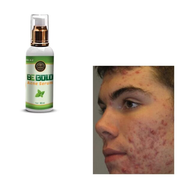 Be Bold Acne Treatment Serum, Cream Herbal Supports Relief of Spots, Blemishes, Whitehead, Blackhead, Pimples Acne Pro active Scar Skincare - Image 8